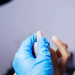Manchas nas unhas: quando buscar um dermatologista para descartar melanoma