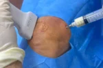 Regulamentação do plasma rico em plaquetas amplia acesso a tratamento de artrose no Brasil