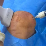 Regulamentação do plasma rico em plaquetas amplia acesso a tratamento de artrose no Brasil