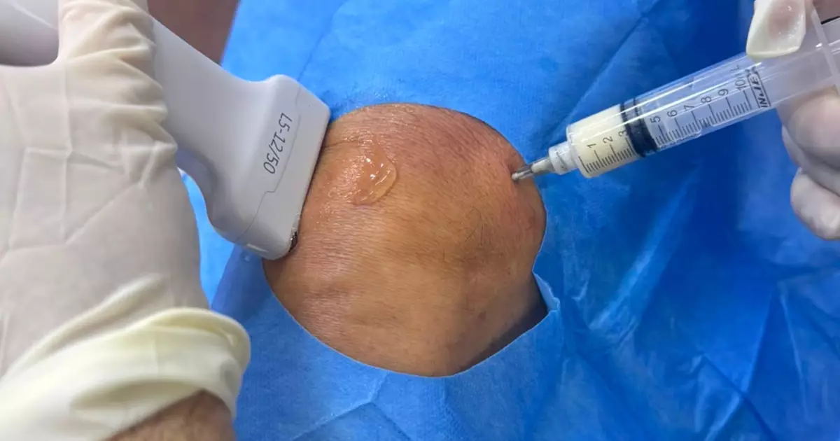 Regulamentação do plasma rico em plaquetas amplia acesso a tratamento de artrose no Brasil