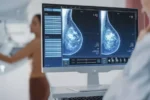 Avanços tecnológicos transformam o tratamento do câncer de mama